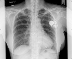 chest X-ray