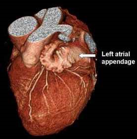 left atrial appendage