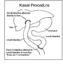 Biliary Atresia