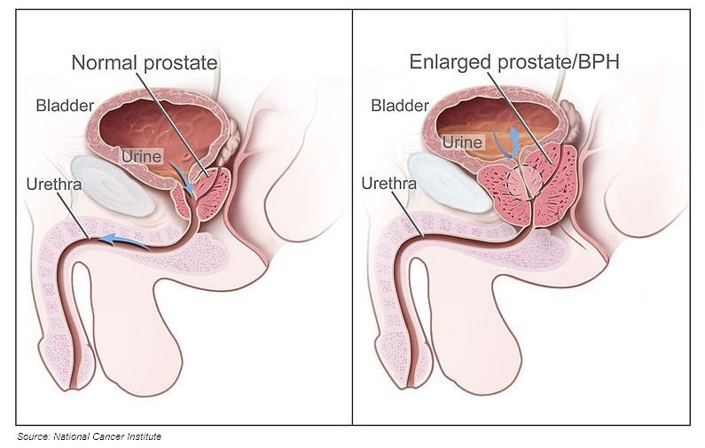 Benign Prostatic Hyperplasia (BPH)