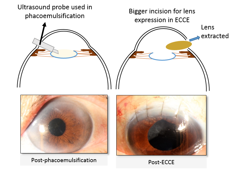 Extracapsular Cataract extraction (ECCE)