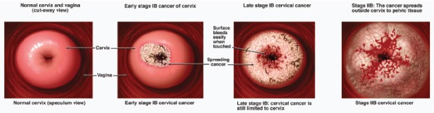 cancer on the cervix