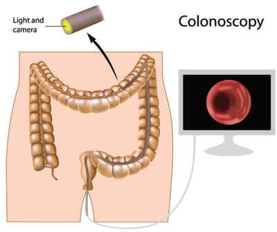 Colonoscopy