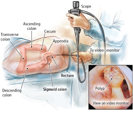 Colonoscopy