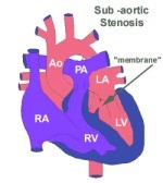 Sub Aortic Stenosis