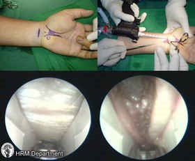 Endoscopic Carpal Tunnel Release Procedure