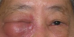 Severe tear duct infection