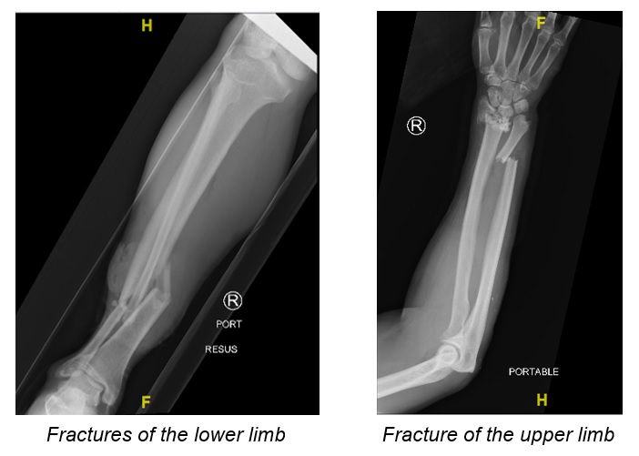 Limbs fractures