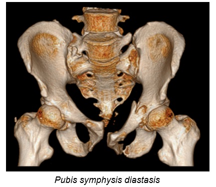 Pubis symphysis diastasis