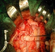 Open sugery