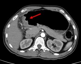 Gastric Cancer (Stomach Cancer) - What It Is, Signs/Symptoms, Diagnosis ...