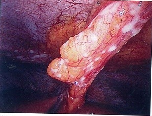 Diagnostic laparoscopy