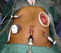 Laparoscopy