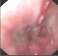 Oesophagitis