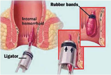 Rubber band ligation