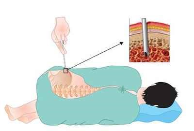 Bone Marrow Biopsy