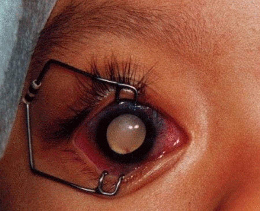 Advanced retinoblastoma - Before