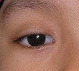 Advanced retinoblastoma - After