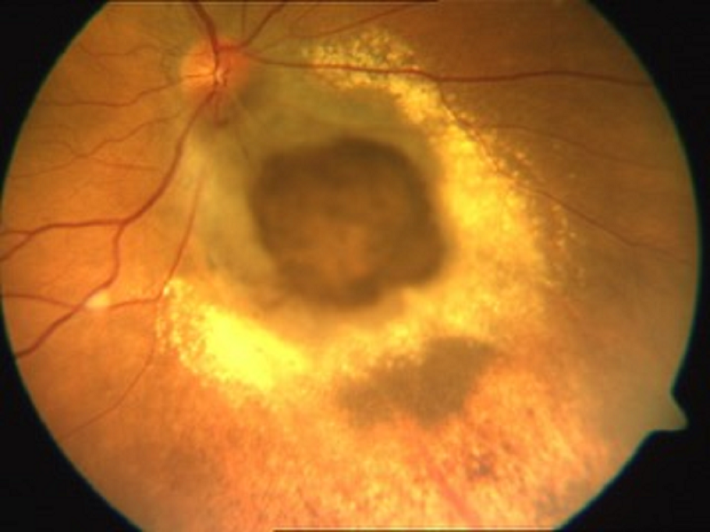 Choroidal melanoma