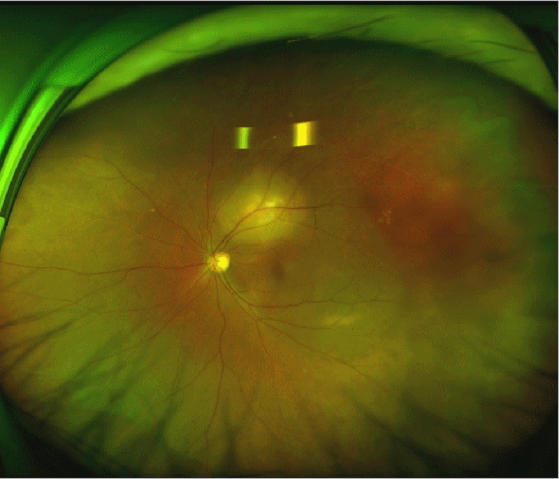 Choroidal metastasis from breast cancer