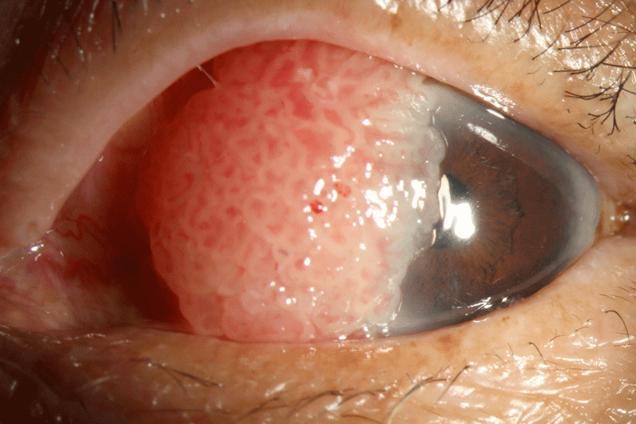 Ocular surface squamous neoplasia - Before