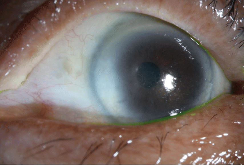 Ocular surface squamous neoplasia - After