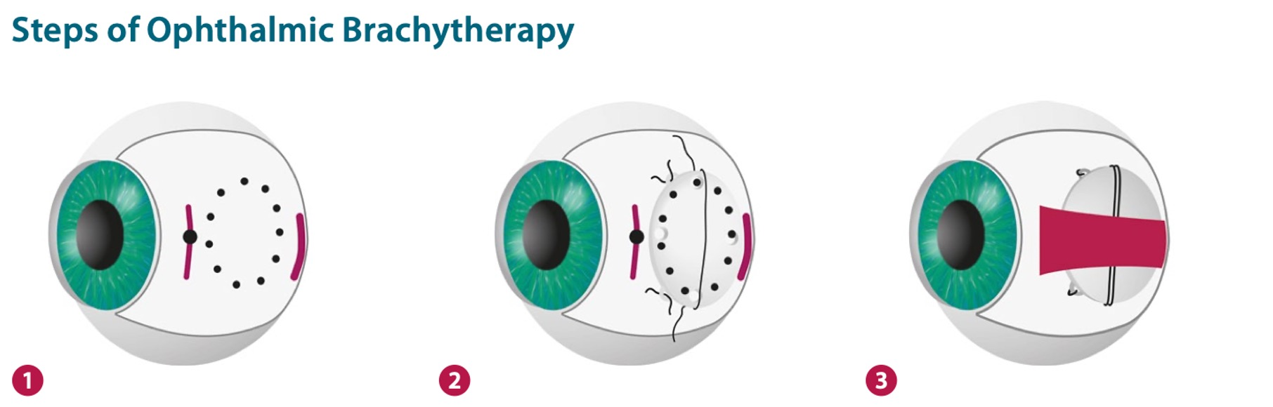 Steps of Ophthalmic Brachytherapy