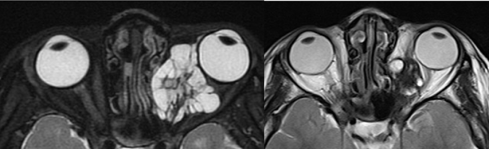 Venolymphatic malformation - Before and after