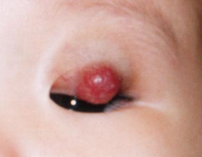 Infantile haemangioma - Before