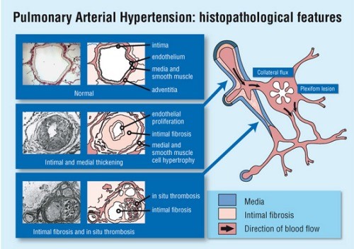Pulmonary Arterial Hypertension histopathological features
