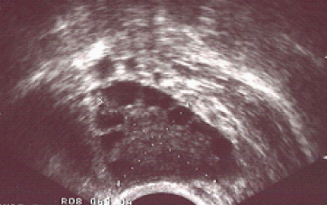 Ultrasound appearance of Polycystic ovary