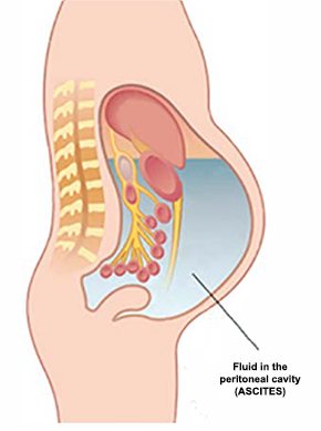 Ascites due to Peritoneal Metastasis