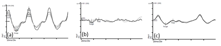 Electroretinogram-ECG