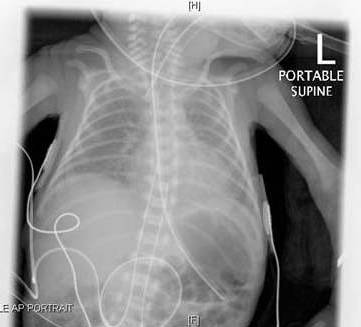 Post-surfactant administration