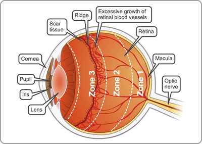 Retinopathy of Prematurity