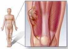 Soft bone Sarcoma