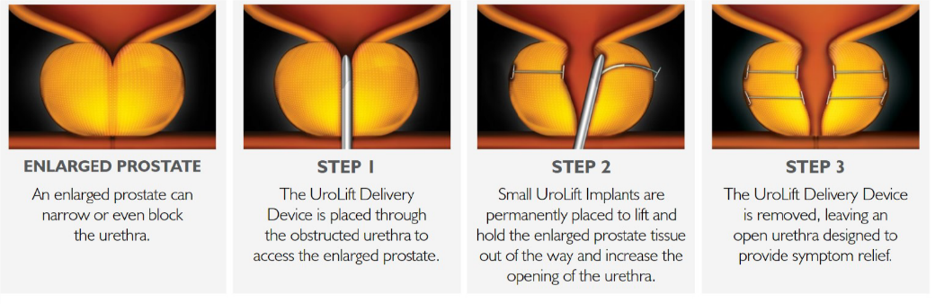 UroLift