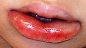 Angioedema - Lips