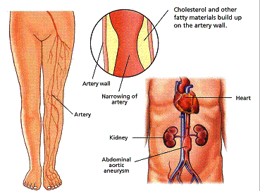 Vascular disease