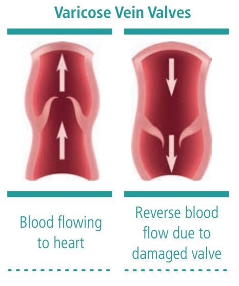 Causes of Varicose Veins